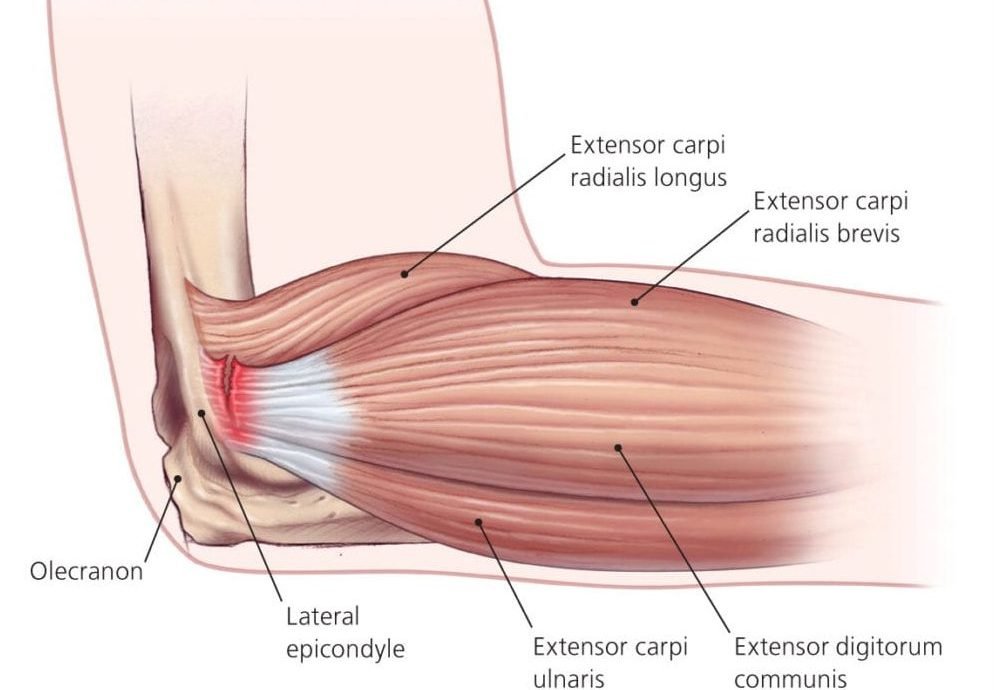 epicondilitis-codo-de-tenista-clinica-de-lesiones-deportivas