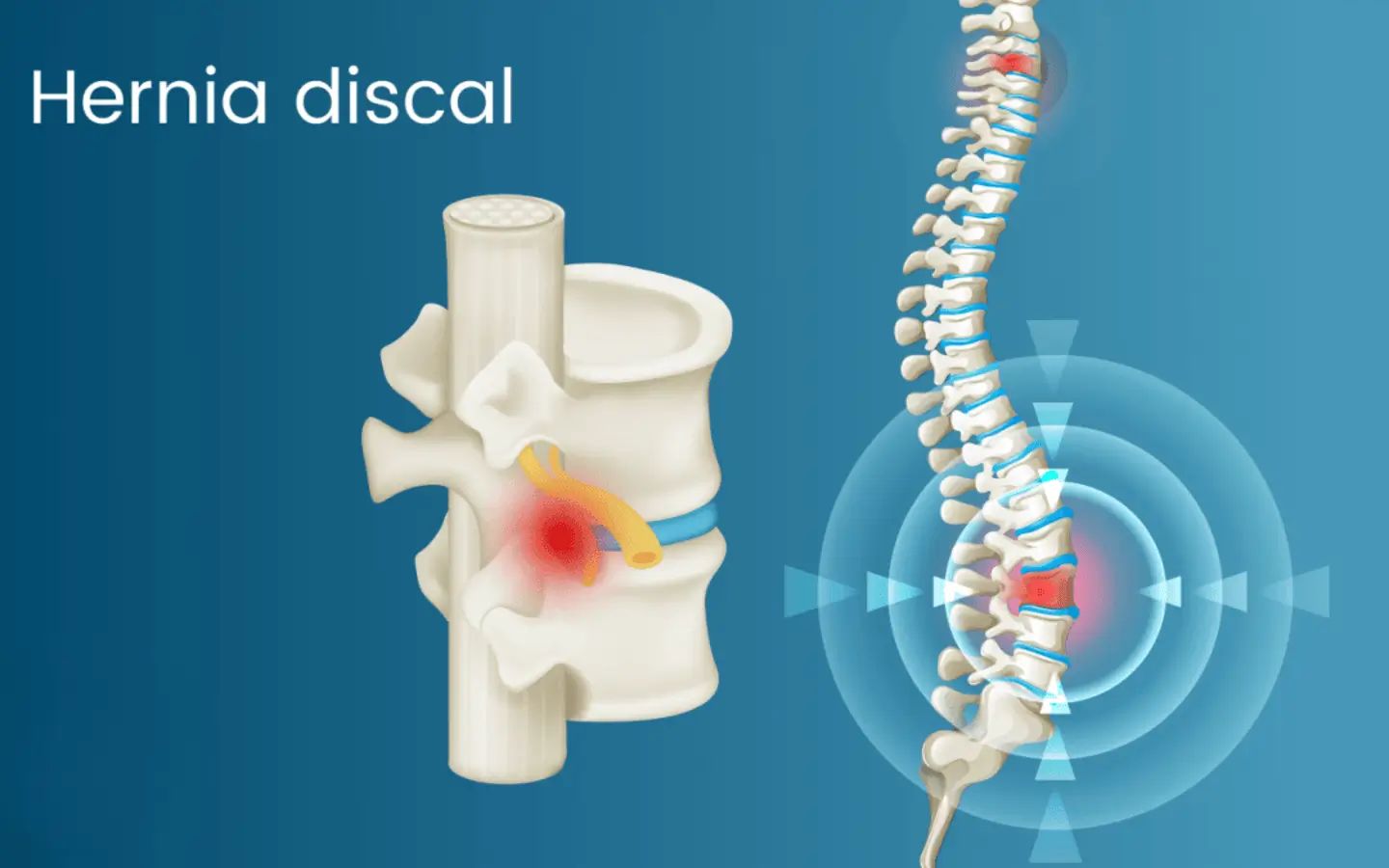 Representación gráfica de la hernia discal lumbar afectando la raíz nerviosa
