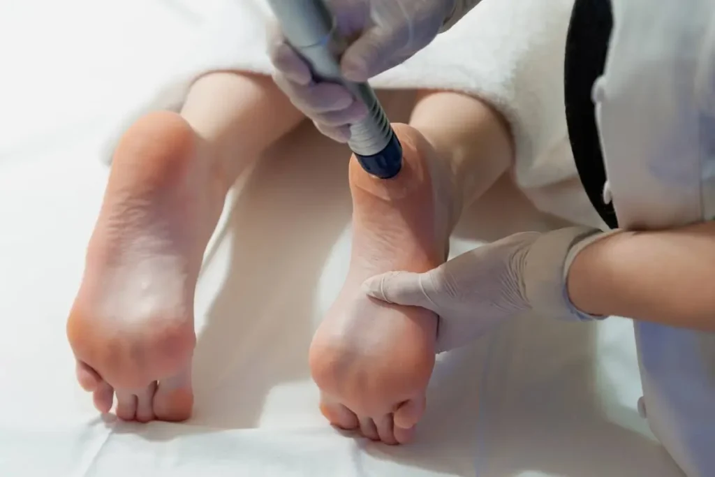 Resultados del tratamiento con ondas de choque focales en fascitis plantar-clinica de lesiones deportivas