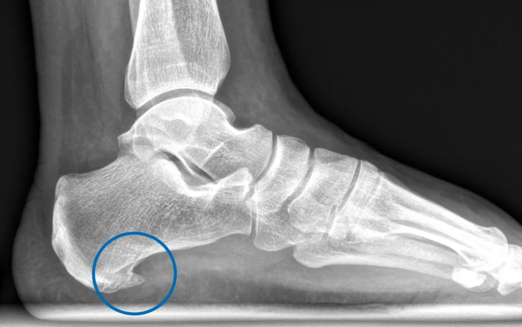 espolón calcáneo Causas, síntomas y tratamiento