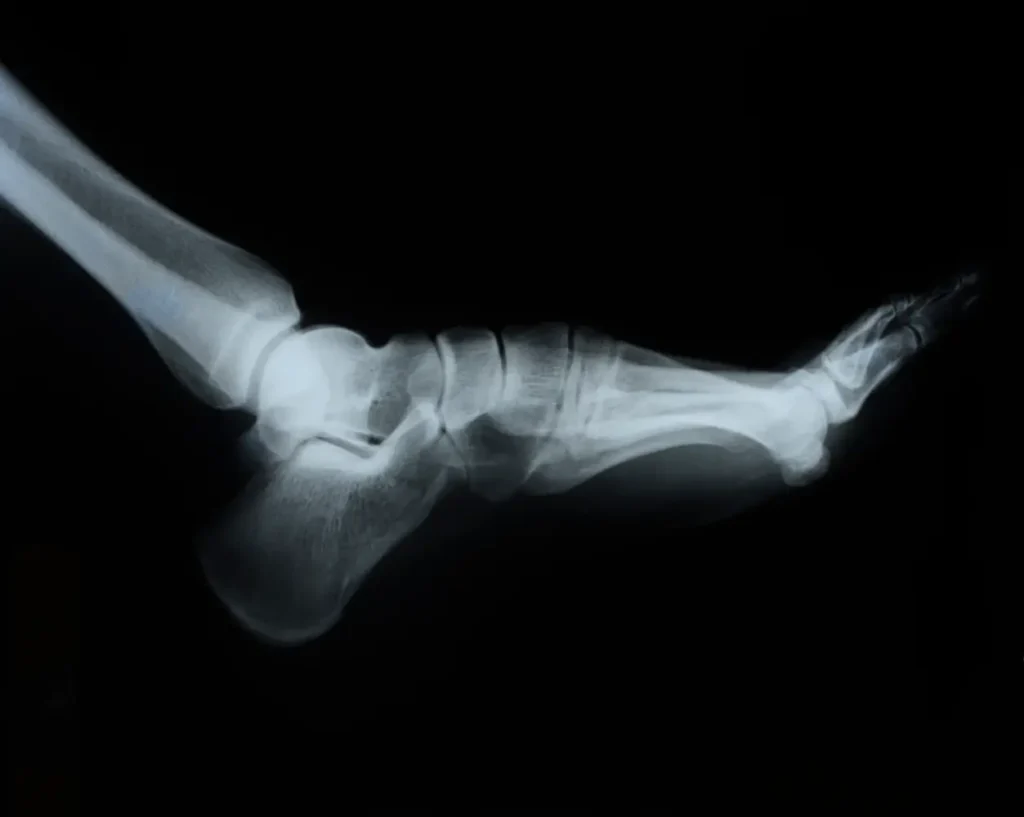 Una radiografía del pie que muestra claramente la presencia de un espolón calcáneo en el hueso del talón