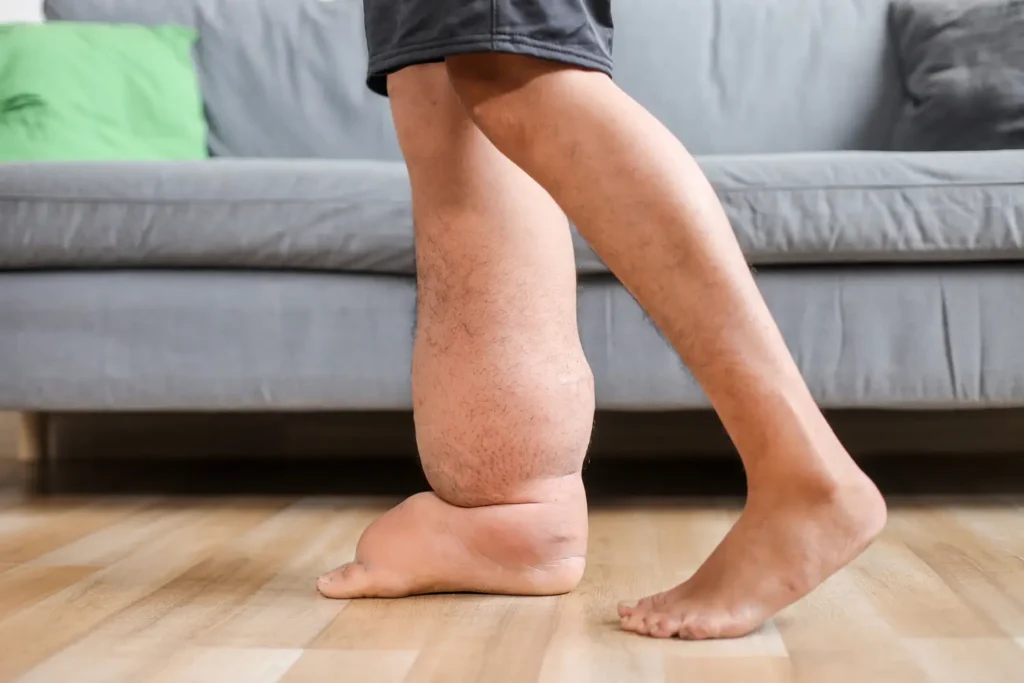 piernas con hinchazón causada por retención de líquidos - clinica de lesiones deportivas